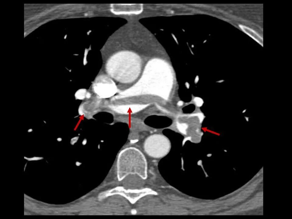 Тромбофлебит легких. Pulmonary Embolism CT. Тромб в легочной артерии. Тромбоз легочной артерии на кт. Массивная эмболия легочной артерии.