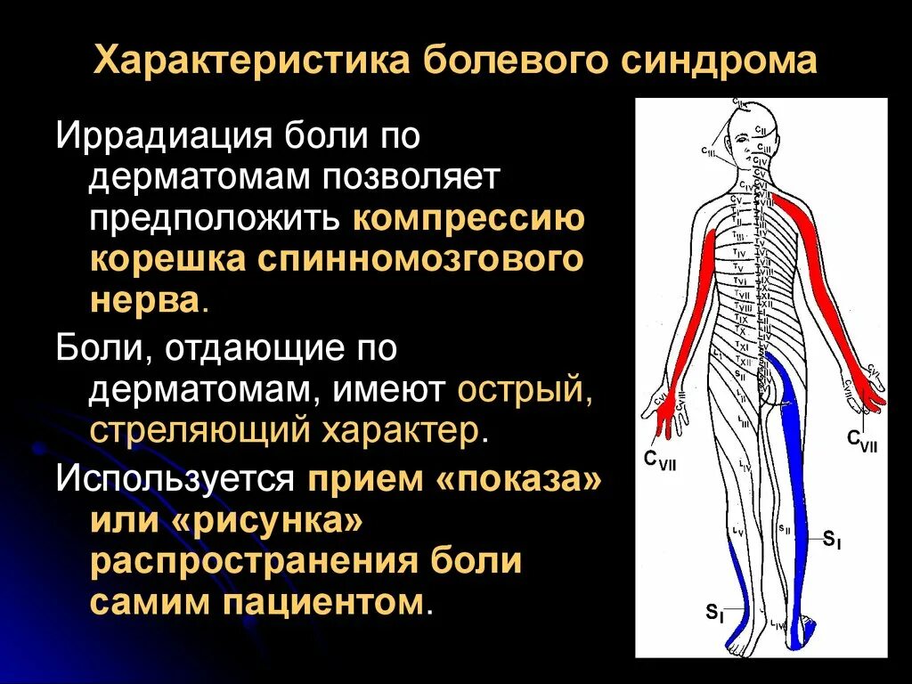 Остеохондроз иррадиация болей. Компрессия спинномозговых Корешков. Иррадиация боли при остеохондрозе. Сдавления корешка спинномозгового нерва.. Боли при остеохондрозе поясничного отдела позвоночника