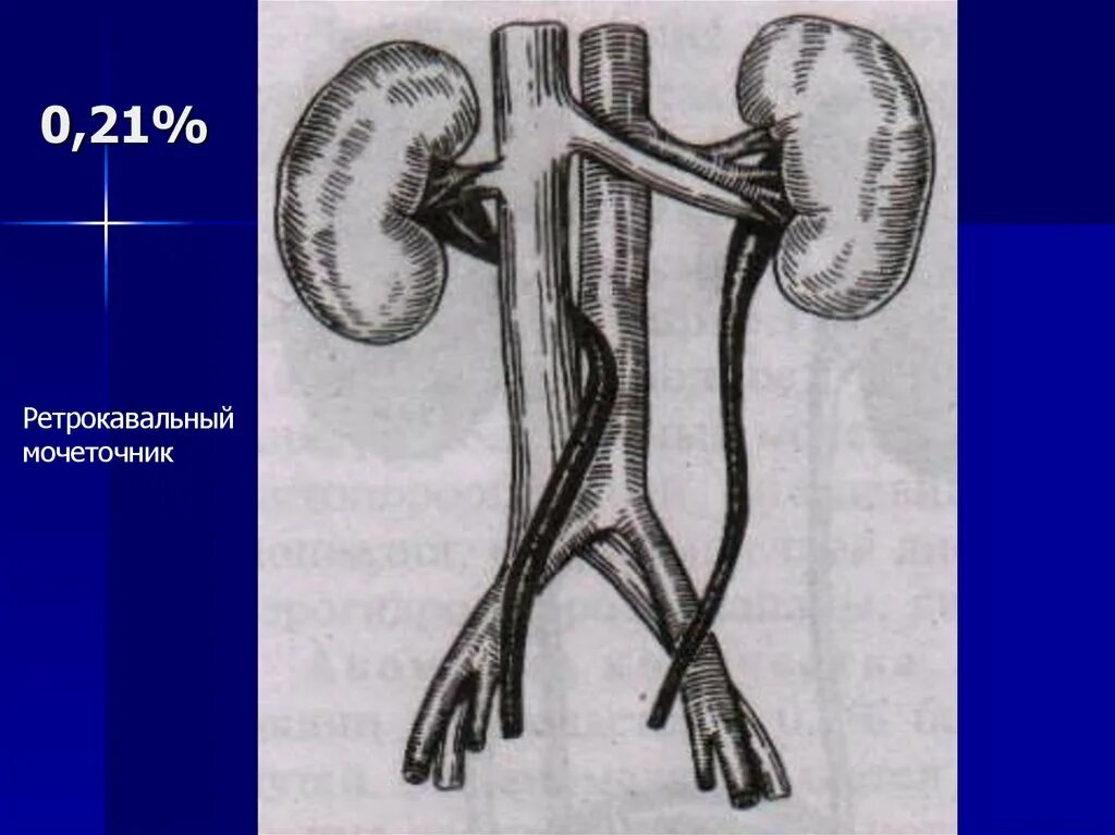Развитие мочеточников. Ретрокавальное расположение мочеточника. Врожденные аномалии мочеточников. Мочеточник ретрокавальный на кт. Ретроилеокальный мочеточник.