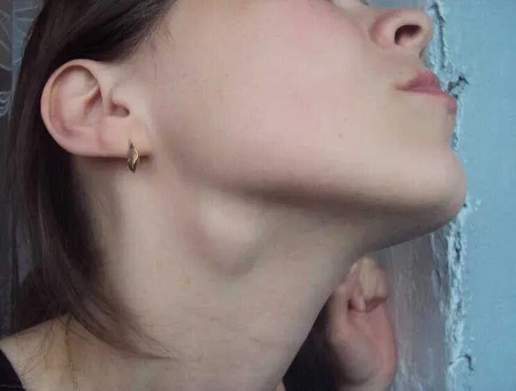 Реактивный синовит коленного сустава. Бурсит коленного сустава жидкость. Воспалённые надключичные лимфоузлы. Лимфогранулематоз лимфоузлы. Анатомическое расположение селезенки.