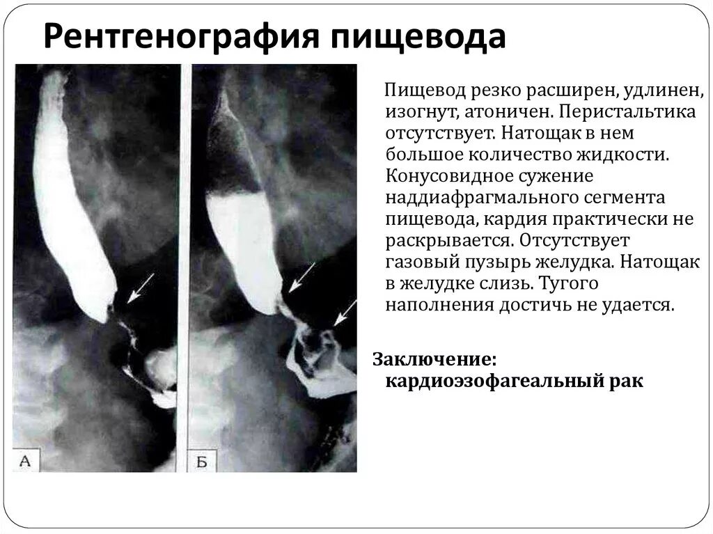 Стриктура пищевода рентген симптомы. Контрастный рентген желудка и пищевода. Патологические сужения пищевода на рентгене. Рефлюкс эзофагит рентген. Скопия пищевода желудка