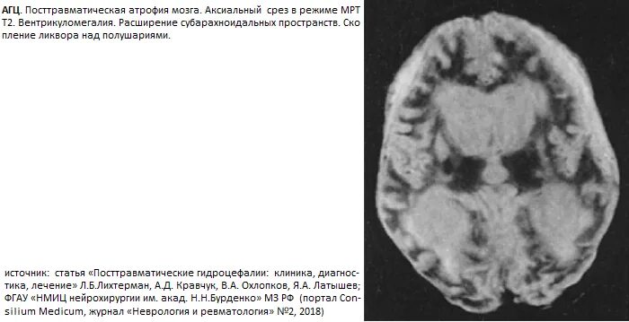 Кистозно атрофические изменения головного. Мрт головного мозга расширение субарахноидальных пространств. Кистозно-атрофические изменения головного мозга мрт. Вентрикуломегалия боковых желудочков. Посттравматическая гидроцефалия кт.