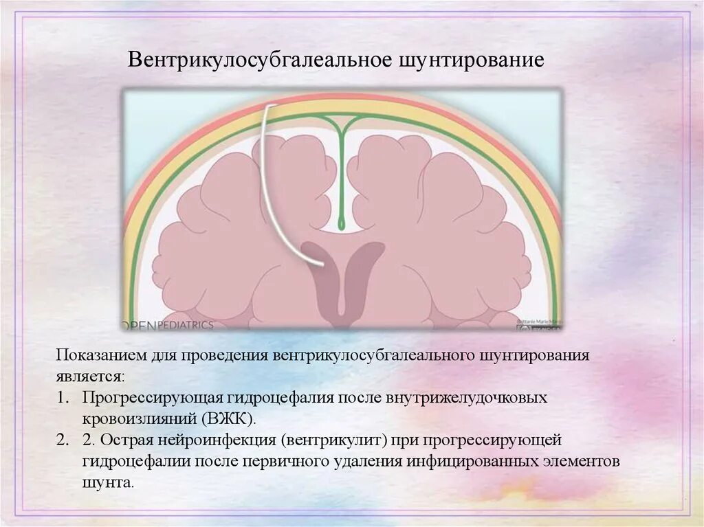 Шунтирование гидроцефалии головного мозга. Вентрикулоперитонеальный шунт. Вентрикуло шунтирование. Вентрикулярный шунт при гидроцефалии.