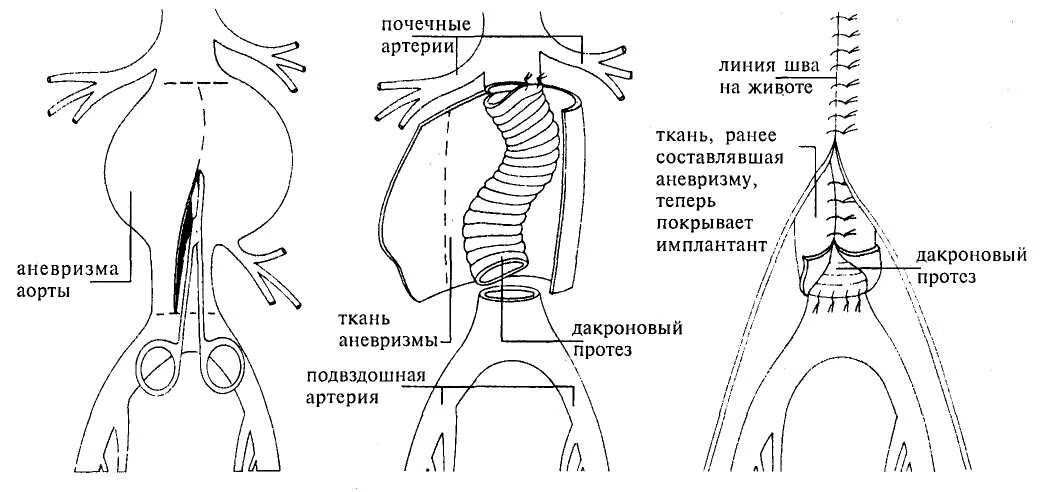 Аневризма аорты после операции. Операция при аневризме брюшной аорты. основные этапы операции при аневризме аорты. операции при аневризмах брюшной аорты. операций при аневризме брюшного отдела аорты.