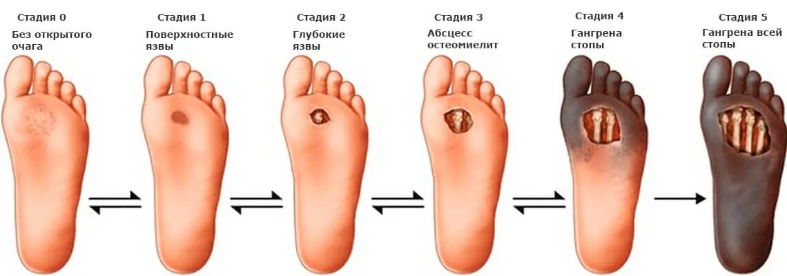 Какого цвета стоп. Синдром диабетической стопы некроз. Диабетическая стопа гангрена ног. Гангрена пальцев стопы диабетическая. Диабетическая стопа гангрена стопы.