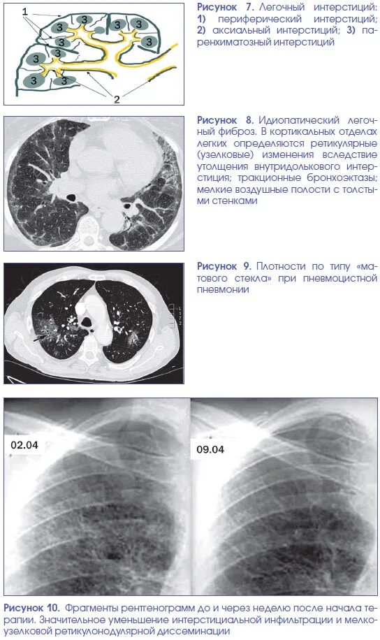 Кт при пневмонии как часто. Параканкрозная пневмония на кт. Коронавирус степень поражения легких кт. Кт при пневмонии как часто. Поражение легких при кт коронавирус.