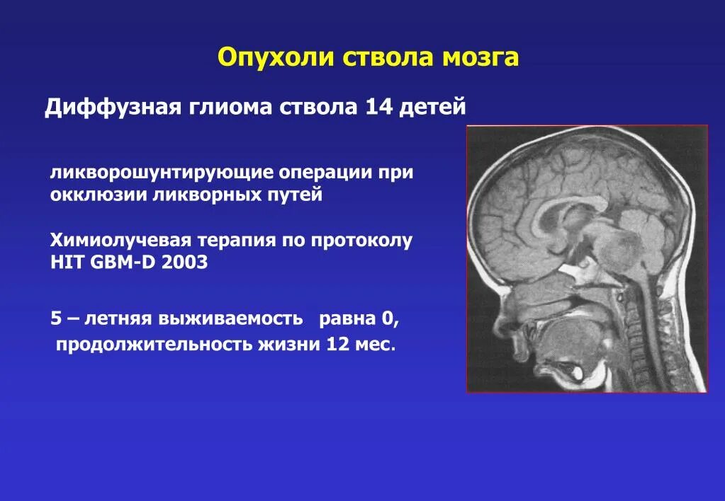 Что такое глиома. Характерный симптом опухоли ствола мозга:. Объемное образование ствола головного мозга. Диффузная глиома ствола мозга.