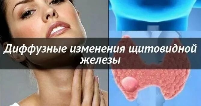 Диффузные изменения щитовидной железы. Диффузионные изменения щитовидной железы. Диффузные изменения ЩЖ. Диффузно-узловые изменения щитовидной железы что это.