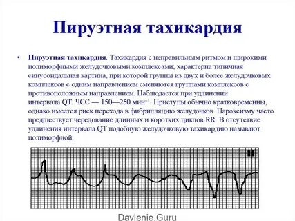 Пируэтная тахикардия