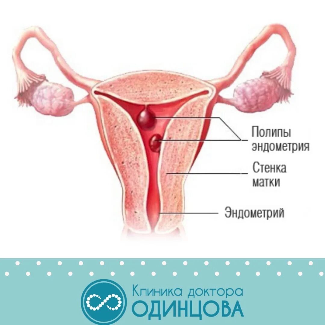 Гинекологические заболевания полипы. Полип эндометрия в матке. Полип в эндометрии матки отзывы