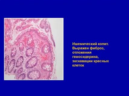 Фиброз слизистой