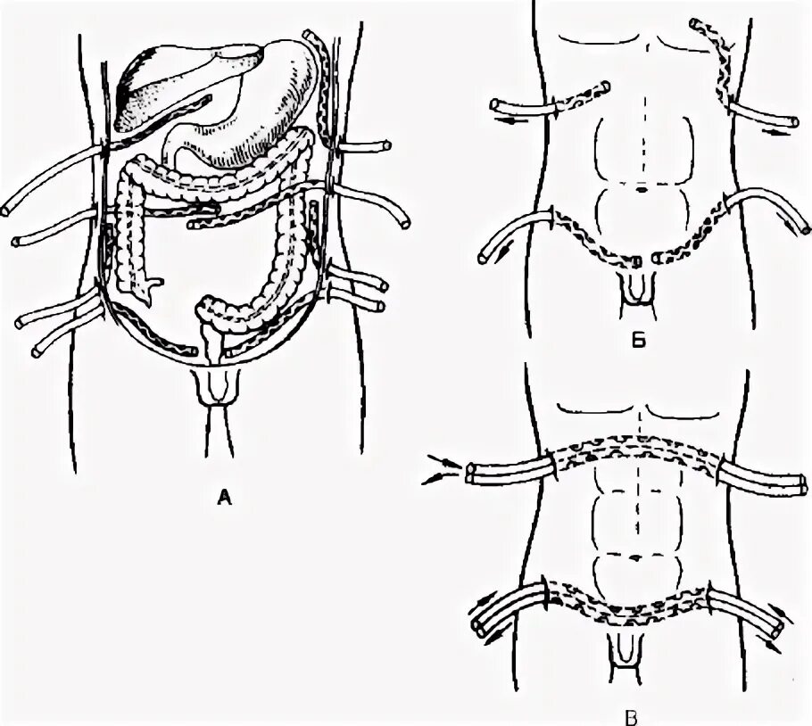 Перитонит дренирование. Аппендэктомия дренирование брюшной полости. Принципы дренирования брюшной полости при перитоните. Дренирование брюшной полости. Перитонит дренирование брюшной полости.