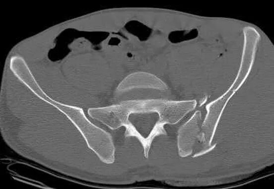 Кт подвздошной кости. Перелом подвздошной кости кт. Перелом костей таза кт. Компьютерная томография переломов костей таза.