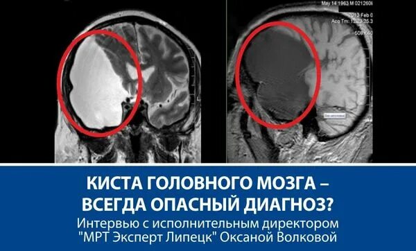 Киста головного мозга причины. Постинфарктная киста головного мозга. Кистозные образования головного мозга.