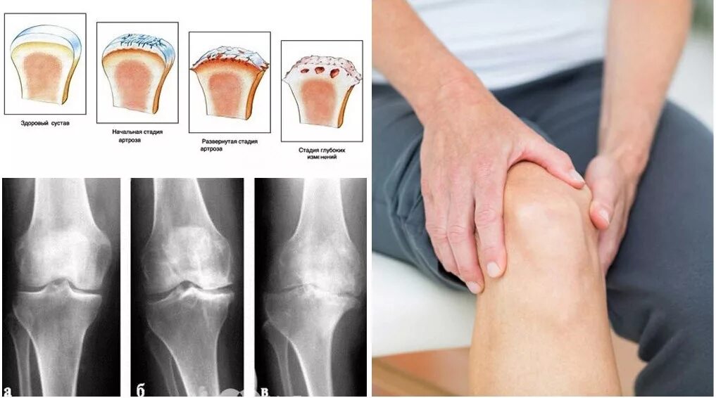 Артропатия коленных суставов. Артрозо-артрит коленного. Артрит коленного сустава в домашних условиях