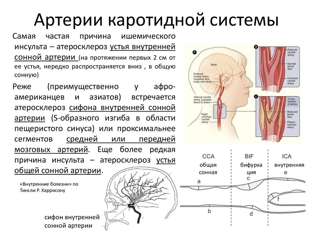 Симптомы атеросклероз общей сонной артерии. Патогенез атеросклероза сонной артерии. Стенозирующий каротидный атеросклероз.