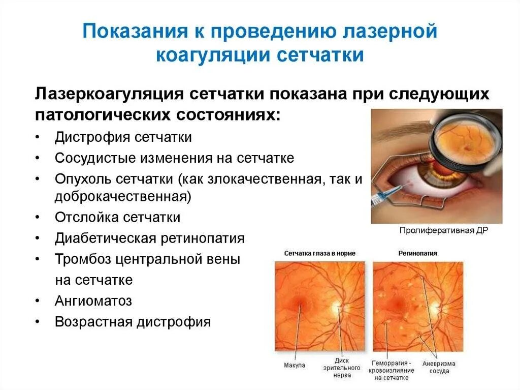 Периферическая профилактическая лазеркоагуляция (ППЛК) сетчатки. Барьерная лазерная коагуляция сетчатки глаза. Лазеркоагуляция сетчатки глаза при отслойке. Отслоение сетчатки глазное дно. Лазерная коагуляция после операции