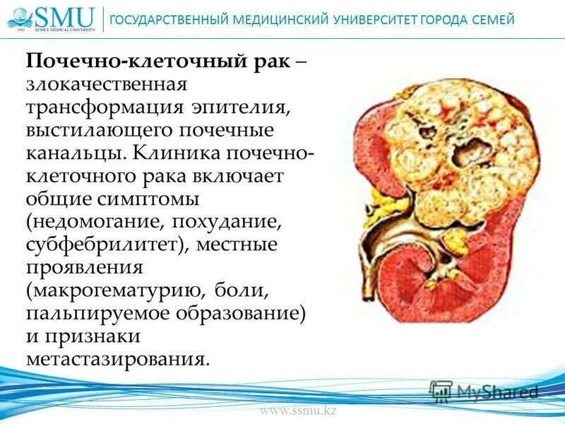 Почечно-клеточная карцинома. Светлоклеточная почечноклеточная карцинома g1 гистология. Метастаз почечно клеточной карциномы. Светлоклеточная аденома надпочечника гистология. Метастазы почечно клеточного рака.