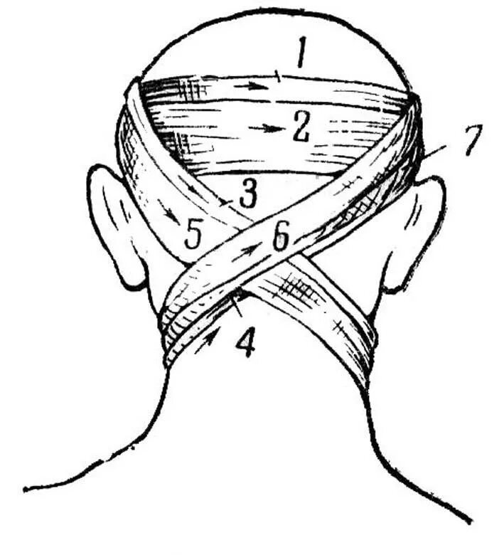 Крестообразная повязка на затылок и шею. Крестообразная повязка на затылок алгоритм. Крестообразная повязка на заднюю поверхность шеи. Техника наложения восьмиобразной повязки на затылочную область. Повязки на голову шею