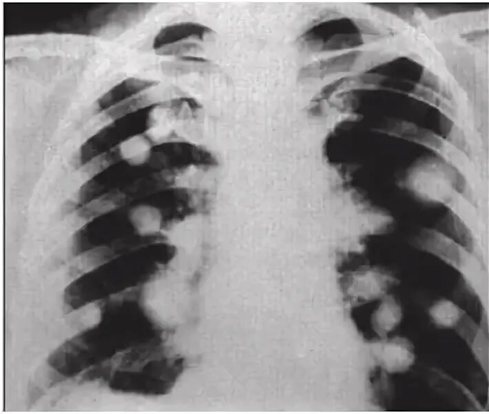 Круглая тень на рентгенограмме легких. Множественные округлые тени в легких. Круглые тени на рентгене легких множественные. Множественные округлые