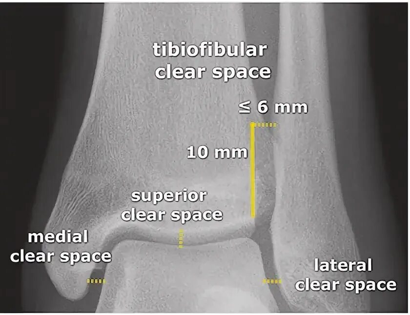 Retroplacental Clear Space. Bursitis of the proximal Tibiofibular Joint MRI.