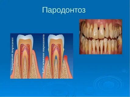 Парадонтозные зубы