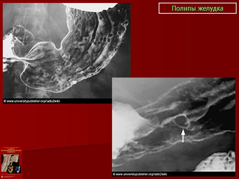 Рентгеносемиотика полип желудка. Рентгеносемиотика оперированного желудка. Париетография пищевода это. Лучевая терапия опухоли желудка. Онкология желудка 4 стадия