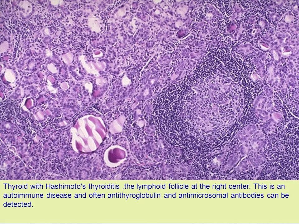 Струма Хашимото патанатомия. Тиреоидит Хашимото гистология. Аутоиммунный тиреоидит Хашимото микропрепарат. Зоб Хашимото гистология. Аутоиммунный зоб