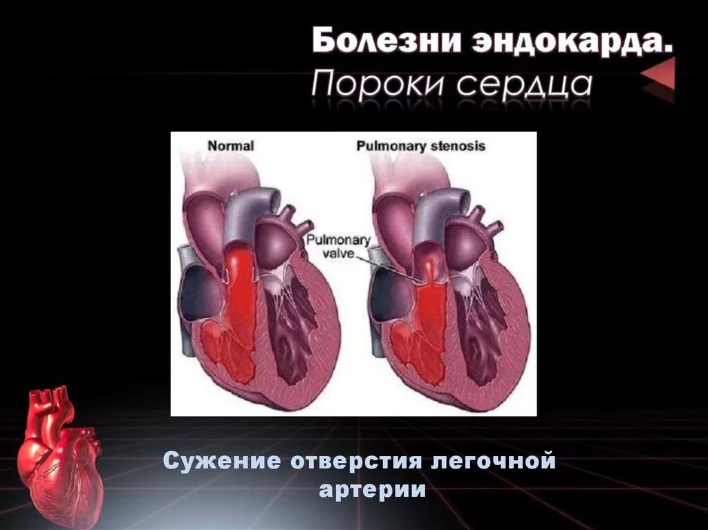 Приобретенные пороки сердца. Заболевания пороков сердца.