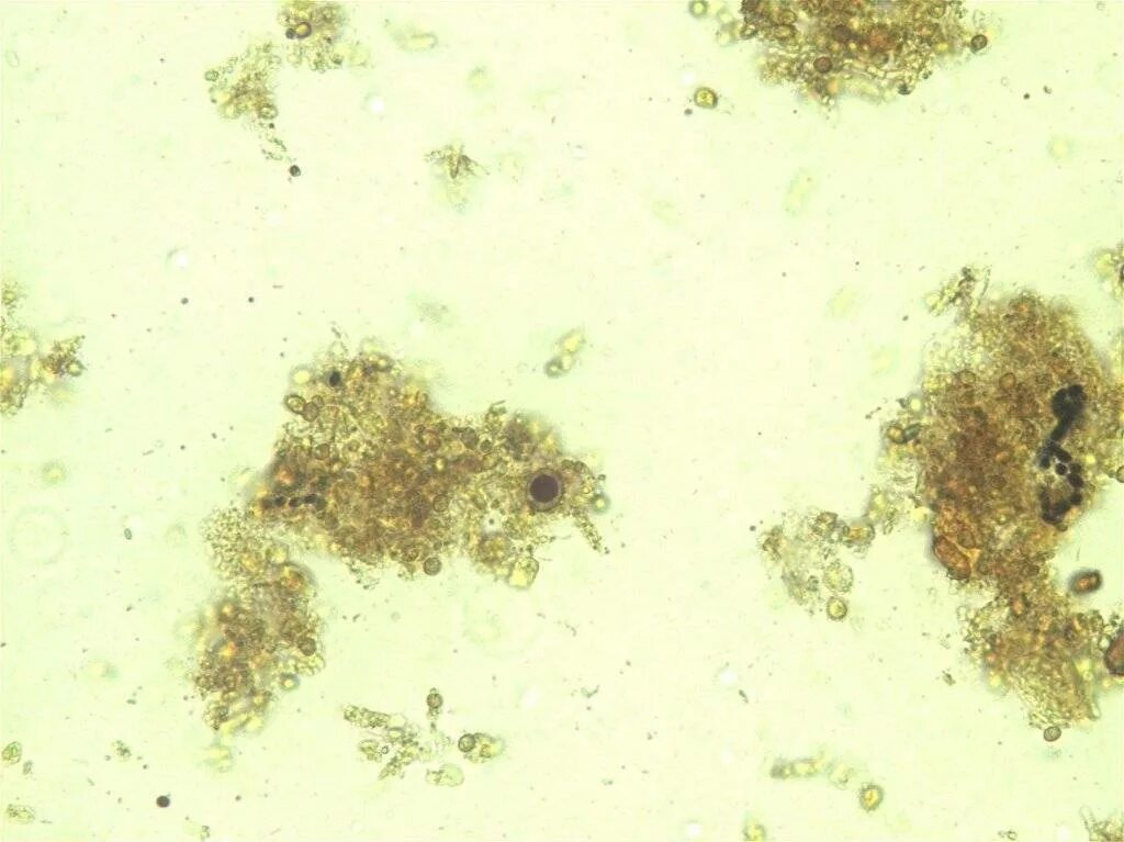 Кальтопроктеин в кале. Йодофильная микрофлора (клостридии).
