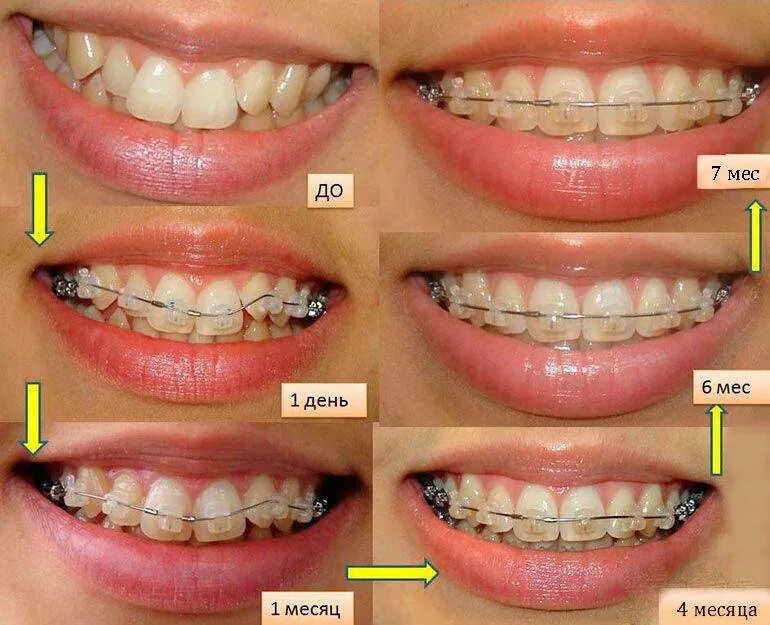 Ровные зубы после брекетов. Кривые зубы до и после брекетов. Зачем нужные пластины