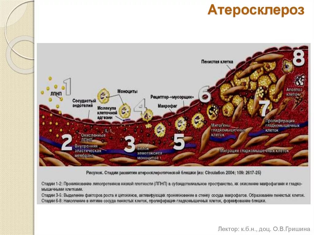Атеросклероз лпнп. Механизм образования атеросклеротической бляшки биохимия. развитие процесса атеросклероза. механизм развития атеросклероза биохимия. схема развития атеросклероза.