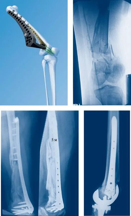 Остеосинтез бедренной большеберцовой кости. Перипротезный перелом бедренной кости остеосинтез. Металлоостеосинтез бедренной кости. Остеосинтез мыщелка большеберцовой кости. Остеосинтез мыщелка
