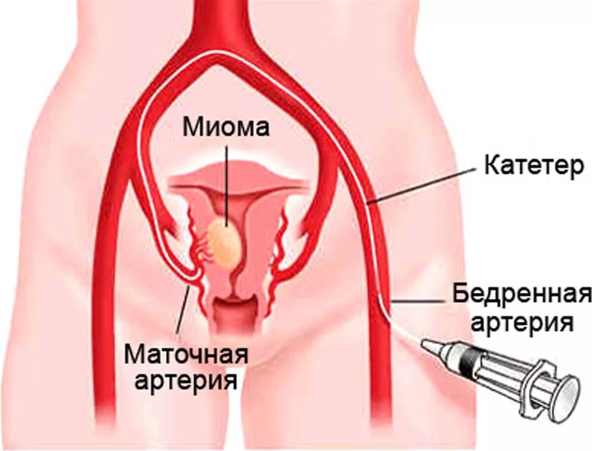 Эма миомы матки. Эмболизация маточных артер й. эмболизация миомы матки. эмболизации маточных артерий при миоме.