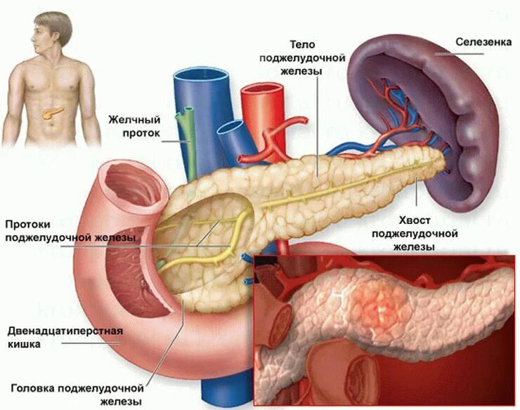 Билиарнозависимый панкреатит симптомы. Острый панкреатит поджелудочной железы. Поджелудочная железа анатомия. Воспалённая поджелудочная железа.