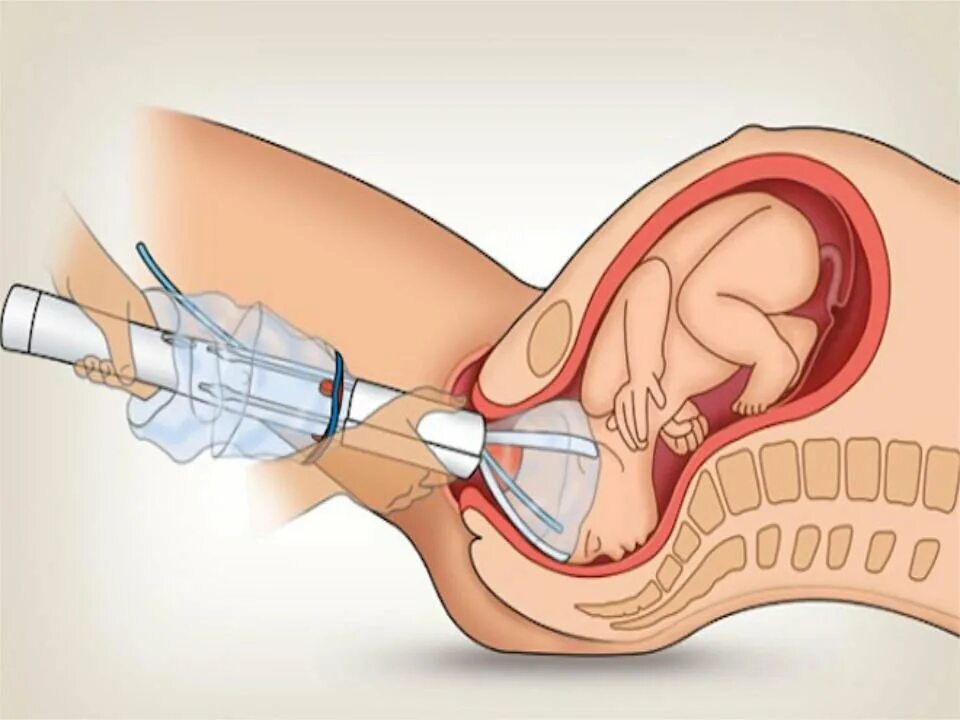 Разрыв при беременности. Вакуумная экстракция плода. Вакуум экстрактор акушерский. Вакууэкстракция плода при беременности. Инструменты для вакуум экстракции плода.