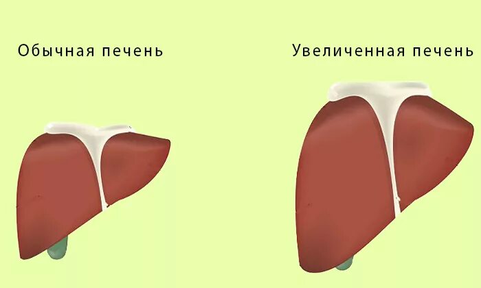 Почему увеличена печень и селезенка. Увеличенная печеньпечень.