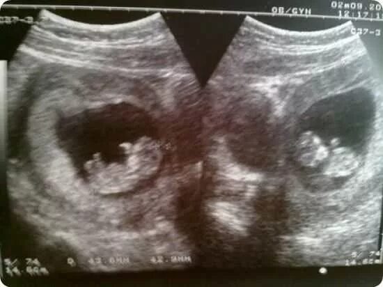 УЗИ на 11 неделе беременности Близнецы. УЗИ 11 недель беременности двойня. Двойня 9 недель беременности фото УЗИ. Двойня 11 недель беременности фото УЗИ.