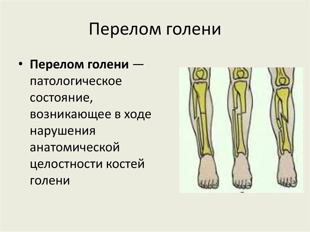 Степени открытого перелома. Чрезмыщелковый перелом костей голени. Закрытый перелом голени карта вызова. Закрытый перелом нижней трети голени карта вызова. Закрытый перелом нижней трети голени.