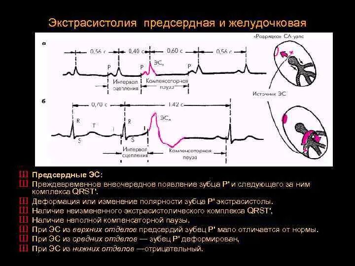 Предсердная экстрасистолия на ЭКГ. Предсердные экстрасистолы на ЭКГ. Желудочковые экстрасистолы на ЭКГ. Предсердная и желудочковая экстрасистолия на ЭКГ. Экстрасистолы ощущения