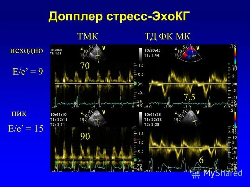 эхокардиография слайд. е е эхокардиография. е е эхокардиография. диастолическая функция эхо кг. гемодинамического стенокардии эхокг.
