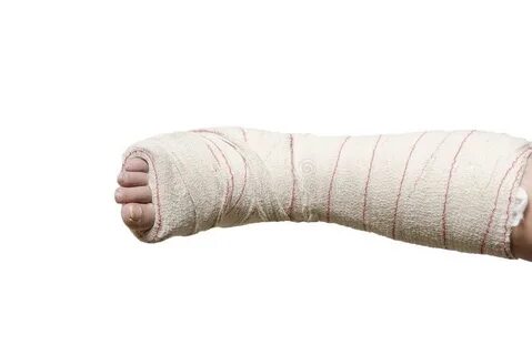 She broke her leg