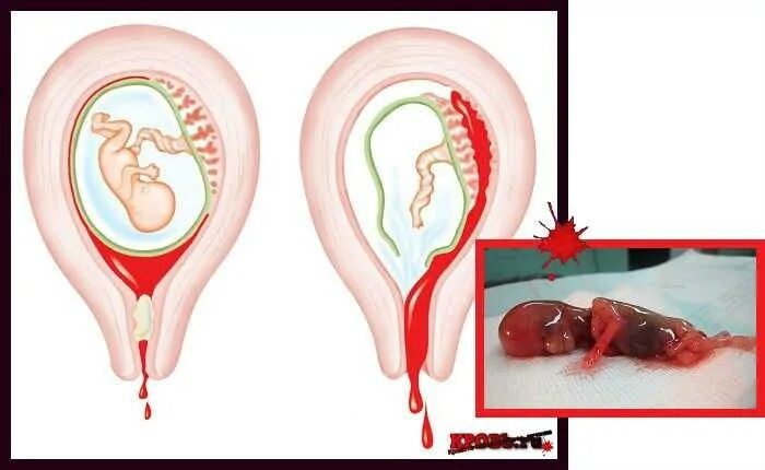 Кровотечение выкидыш на раннем сроке. Медикаментозный аборт плодное яйцо. Пошла кровь после родов