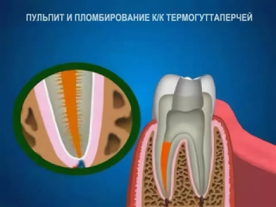 Временное пломбирование каналов зуба. Пульпит зуба гуттаперча. Пломбирование гуттаперчевыми штифтами. Пломбирование корневого канала зуба гуттаперчевыми штифтами. Пульпит пломбировка каналов.