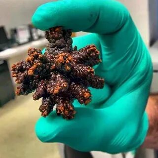 Могут ли сами камни растворяться в почках