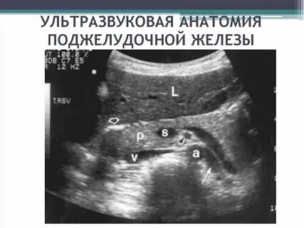 Что такое липоматоз поджелудочной железы 1 степени