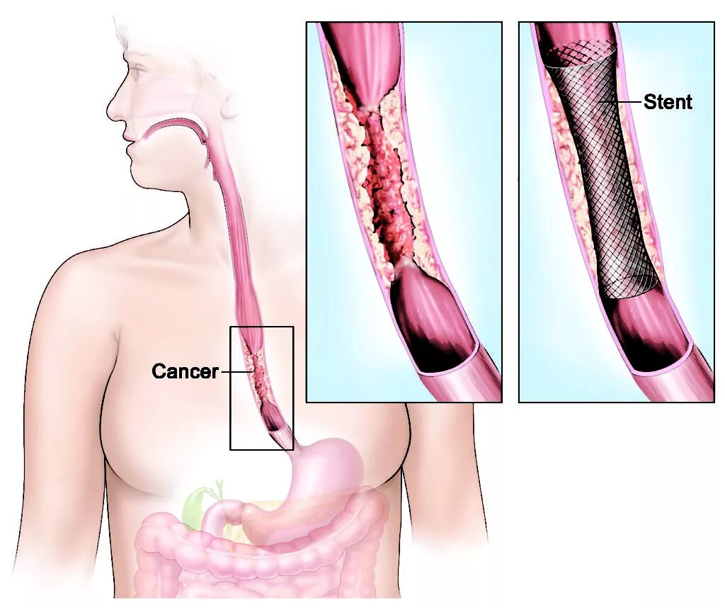 Болит стент. Стриктура пищевода эзофагит. Бужирование стриктуры пищевода. Стентирование опухолевого стеноза пищевода. Стент Даниша стентирование пищевода.