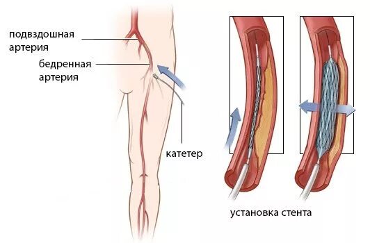 Баллонная ангиопластика нижних конечностей. Баллонная ангиопластика и стентирование нижних конечностей. Ангиопластика сосудов нижних конечностей. Стентирование сосудов конечностей. Шунтирование и стентирование артерий нижних конечностей.