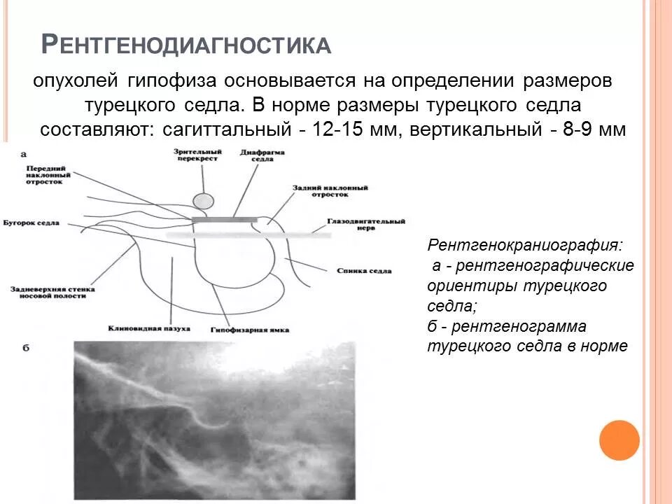 Гипофиз седло. Рентген турецкого седла опухоль гипофиза. Турецкое седло на рентгене в норме и при патологии. Измерение турецкого седла на рентгенограмме. Нормы турецкого седла рентген у детей.