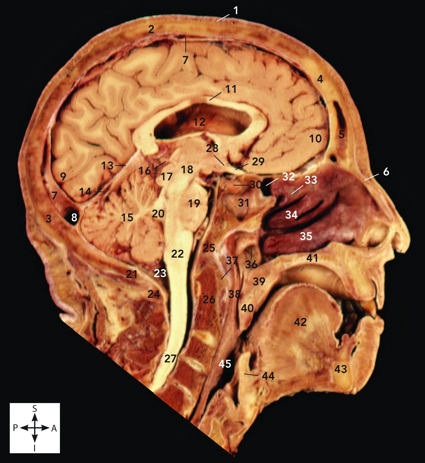 Голова головной мозг шея. Tentorium голова. Nasal Bone fetus.